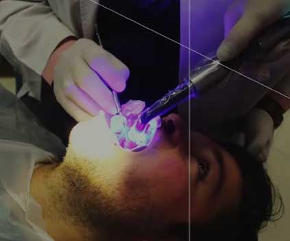 تیزر دندان پزشکی